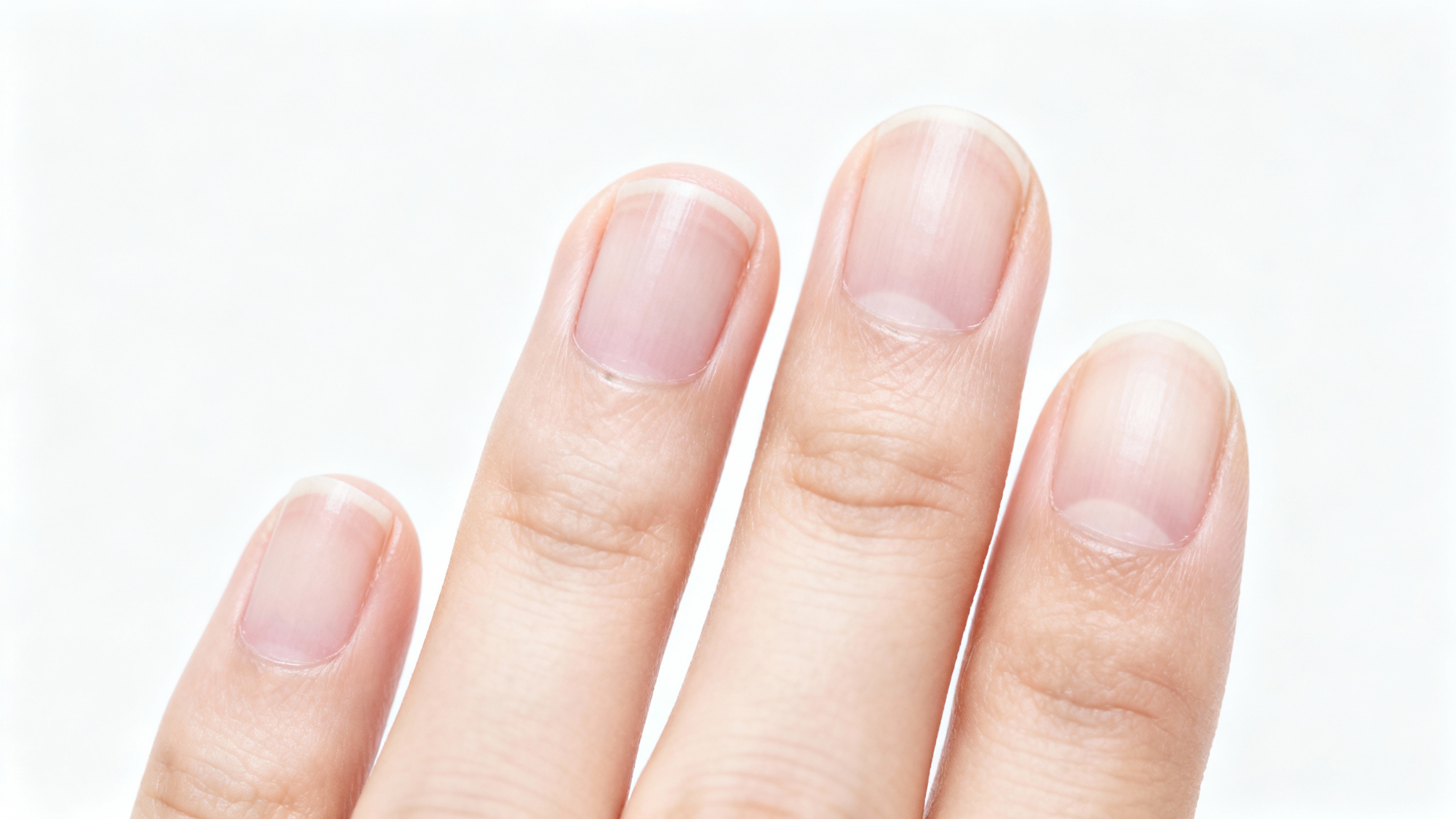 Featured image for The Top Misconceptions about White Superficial Onychomycosis Debunked